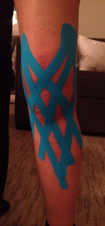Kinesio Tape for Swelling
