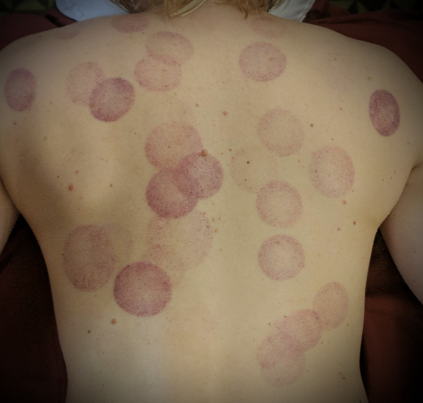 Massage Cupping For Lymphatic Circulation And Superior Bodywork Results
